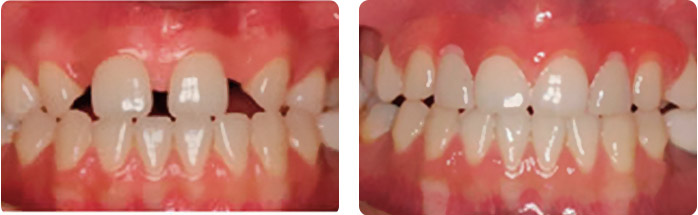 Диастема и тремы зубного ряда