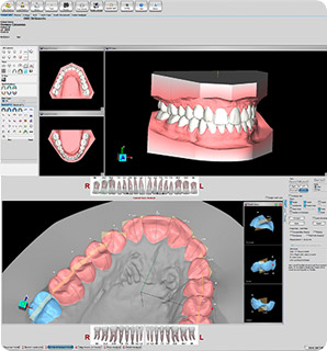 Виртуальная SetUp-модель (модель зубов после лечения)