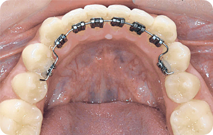 2D лингвальные брекеты на зубы обеспечивают максимальный комфорт для пациента