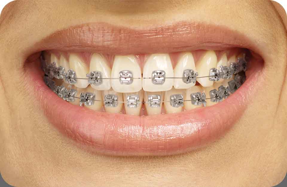 Металлические самолигирующие брекеты БиоКвик на зубах